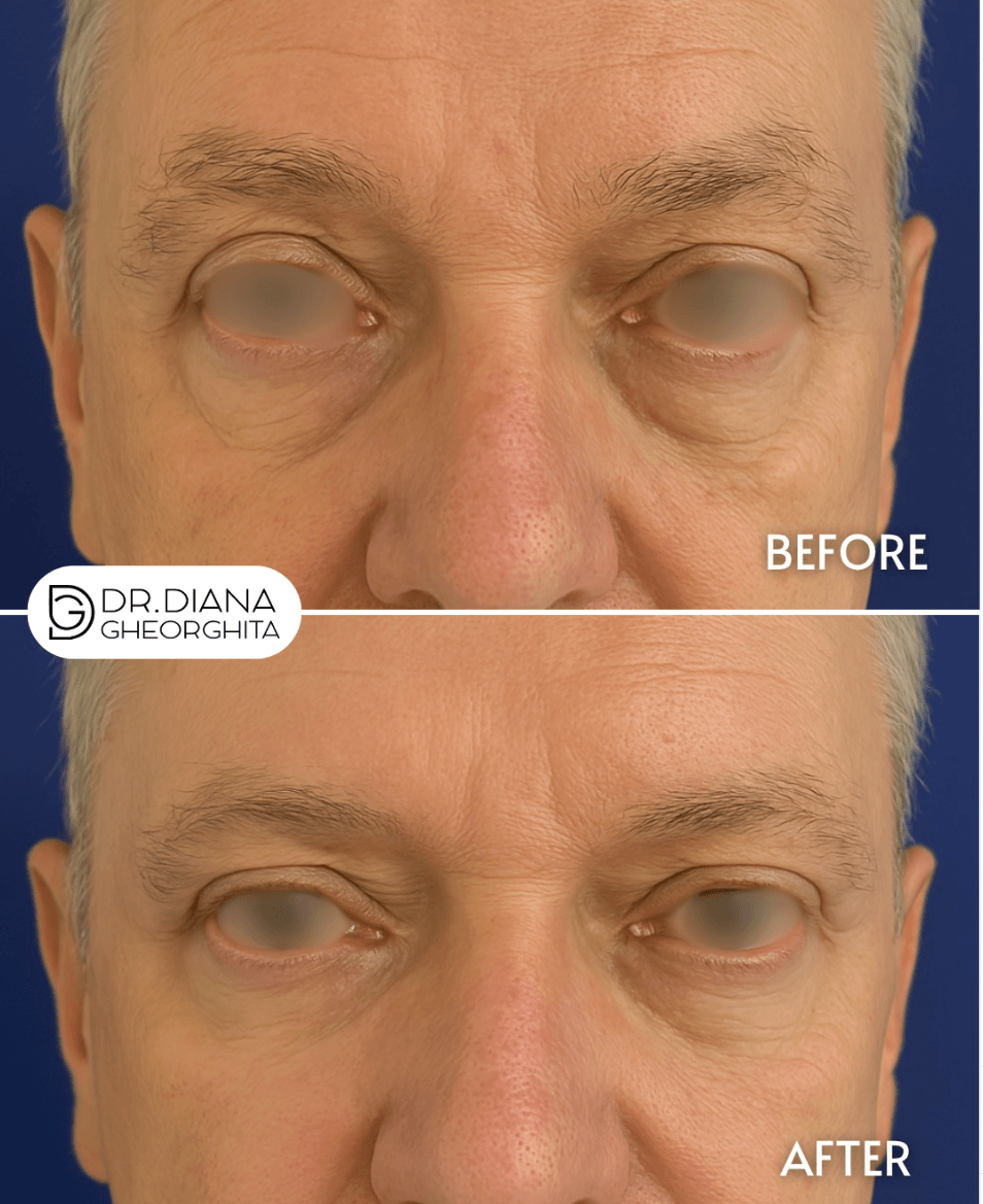 Blefaroplastia inferioară – inainte si dupa