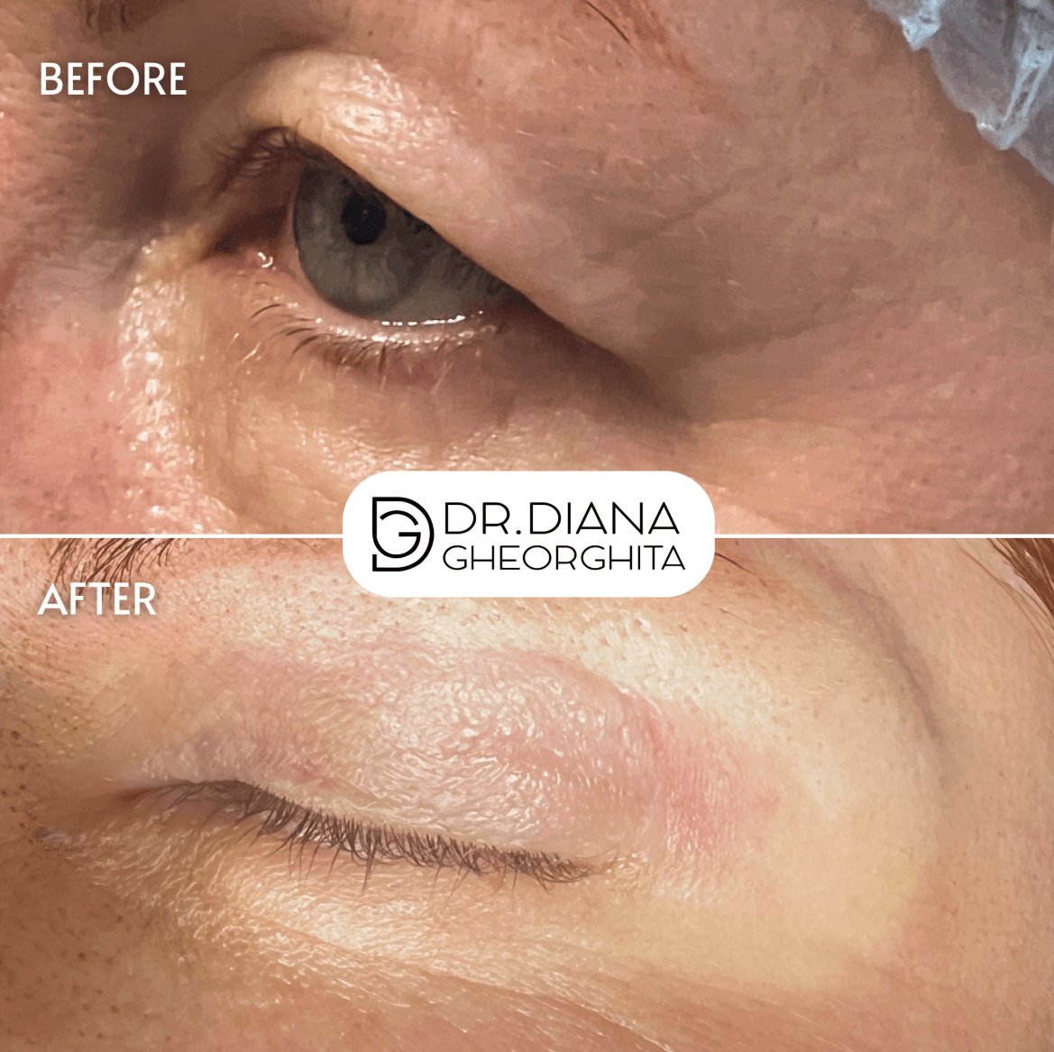 Blefaroplastia superioară – inainte si dupa