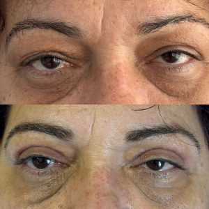 Blefaroplastie blefaroplastie_superioara_dr_diana_gheorghita_17