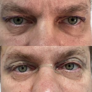 Blefaroplastie blefaroplastie_superioara_dr_diana_gheorghita_13