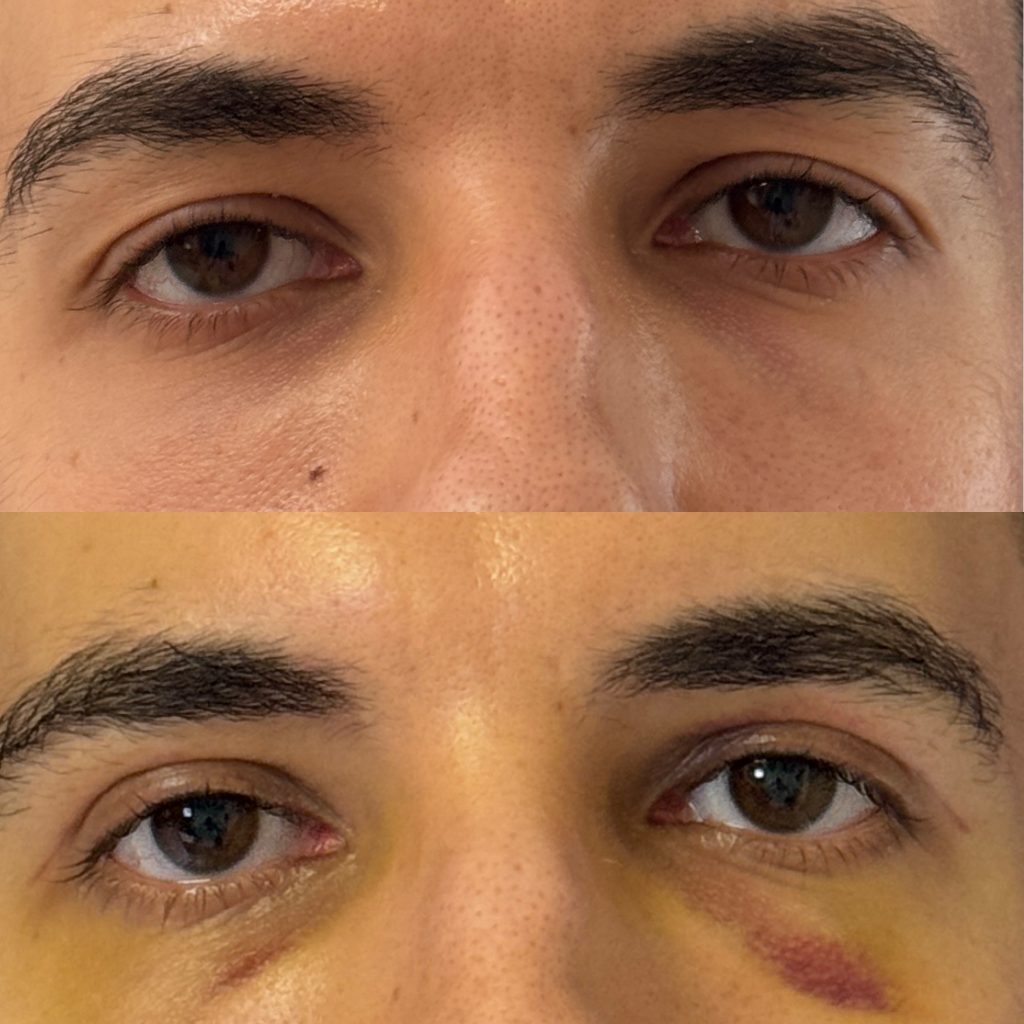 Blefaroplastie blefaroplastie_inferioara_dr_diana_gheorghita_10