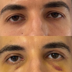 Blefaroplastie blefaroplastie_inferioara_dr_diana_gheorghita_10
