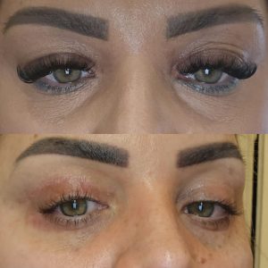 Blefaroplastie blefaroplastie_superioara_dr_diana_gheorghita_16