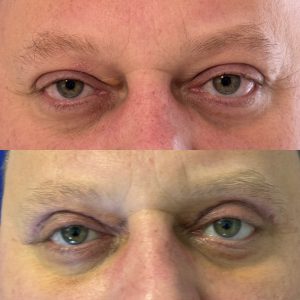Blefaroplastie blefaroplastie_superioara_dr_diana_gheorghita_12