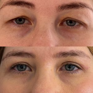 Blefaroplastie blefaroplastie_superioara_dr_diana_gheorghita_11