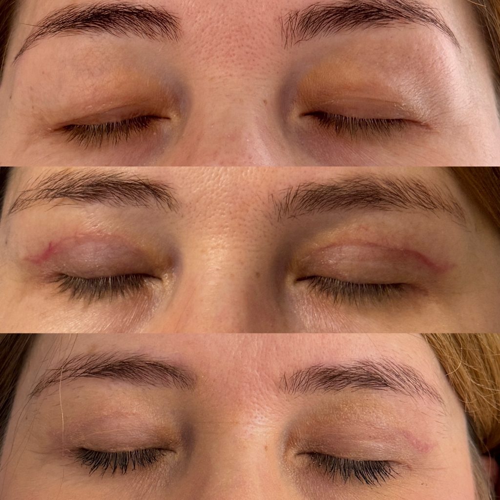 Blefaroplastie blefaroplastie_dr_diana_gheorghita_6