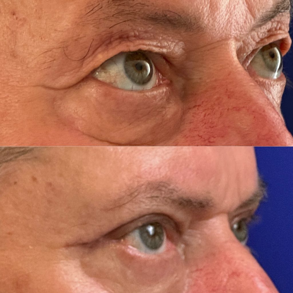 Blefaroplastie blefaroplastie_dr_diana_gheorghita_7