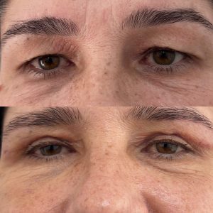 Blefaroplastie blefaroplastie_dr_diana_gheorghita_8