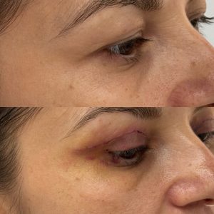 Blefaroplastie blefaroplastie_dr_diana_gheorghita_5