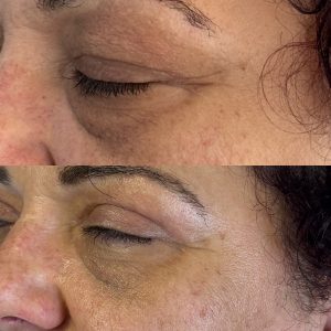 Blefaroplastie blefaroplastie_dr_diana_gheorghita_4