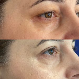 Blefaroplastie blefaroplastie_dr_diana_gheorghita_3