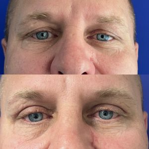 Blefaroplastie blefaroplastie_dr_diana_gheorghita_2