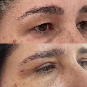 Blefaroplastie blefaroplastie_inainte_dupa