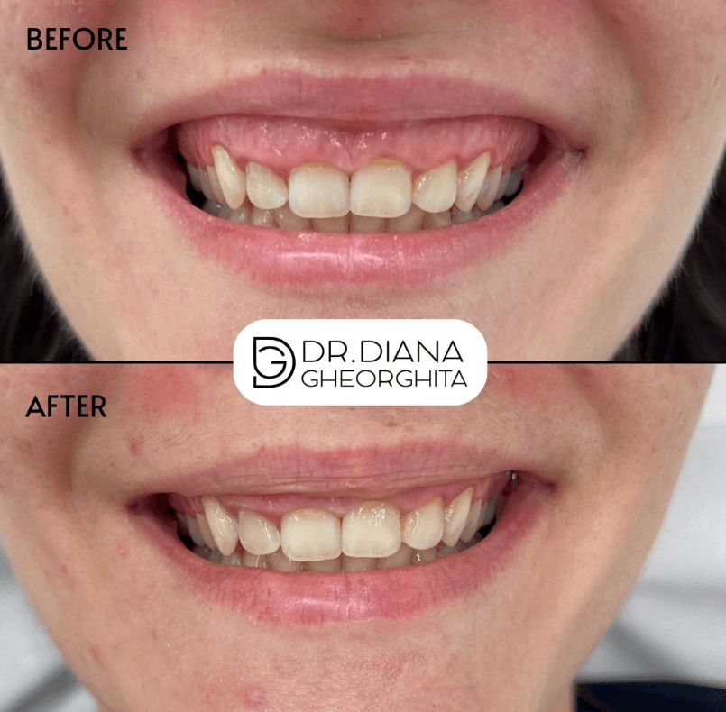 Gummy smile zambet gingival