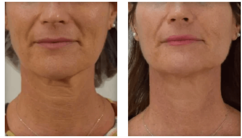 Profhilo: Rejuvenarea pielii în 4 pași simpli Profhilo