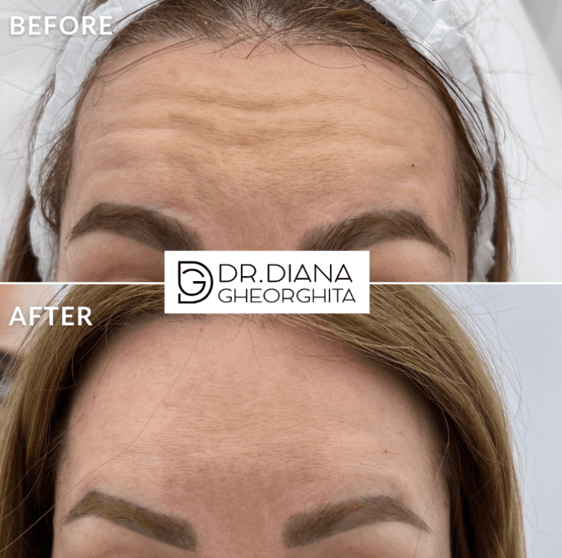 Tratament riduri acid hialuronic