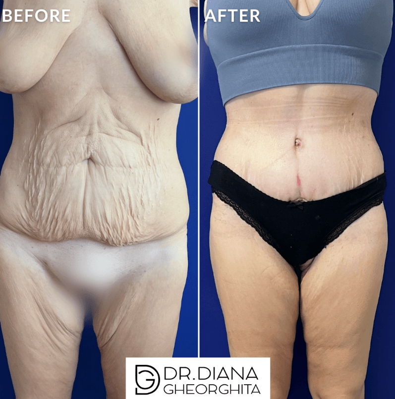 abdominoplastie poze