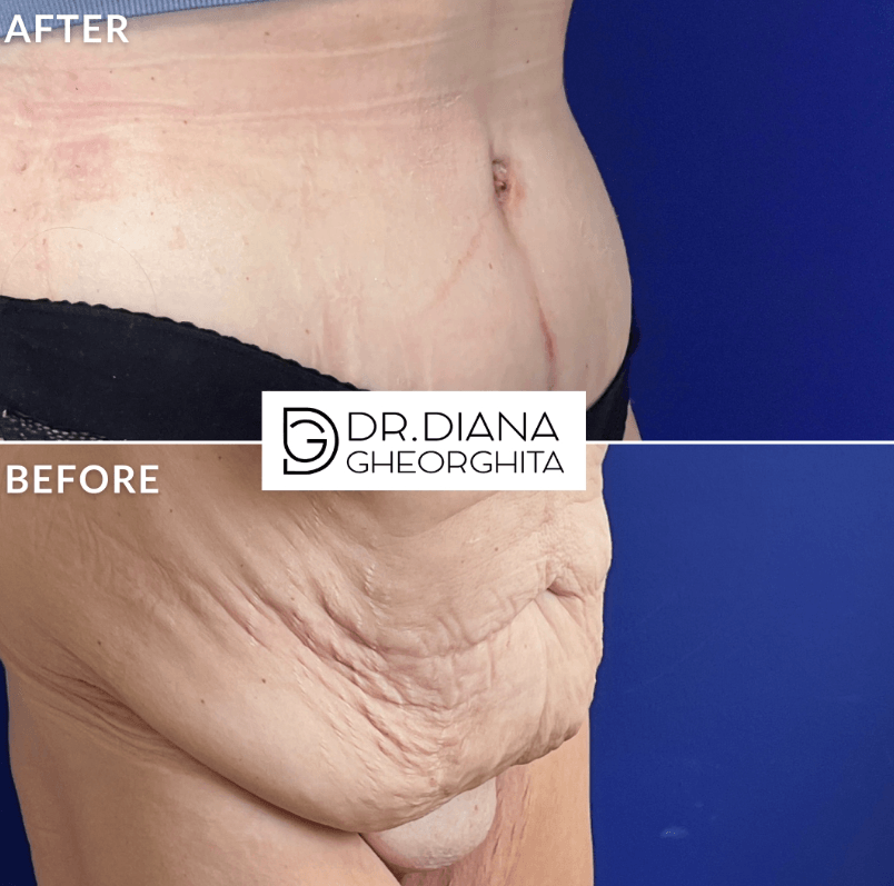 abdominoplastie poze