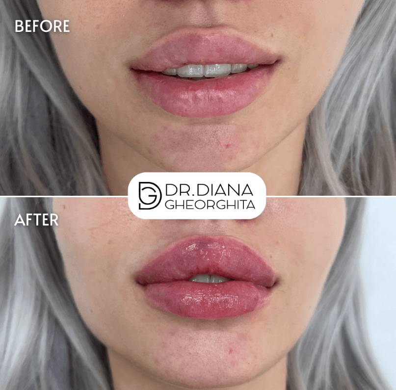 buze acid hialuronic