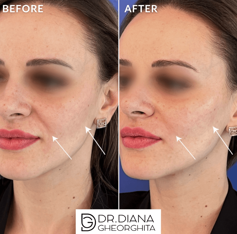 acid hialuronic în pomeți