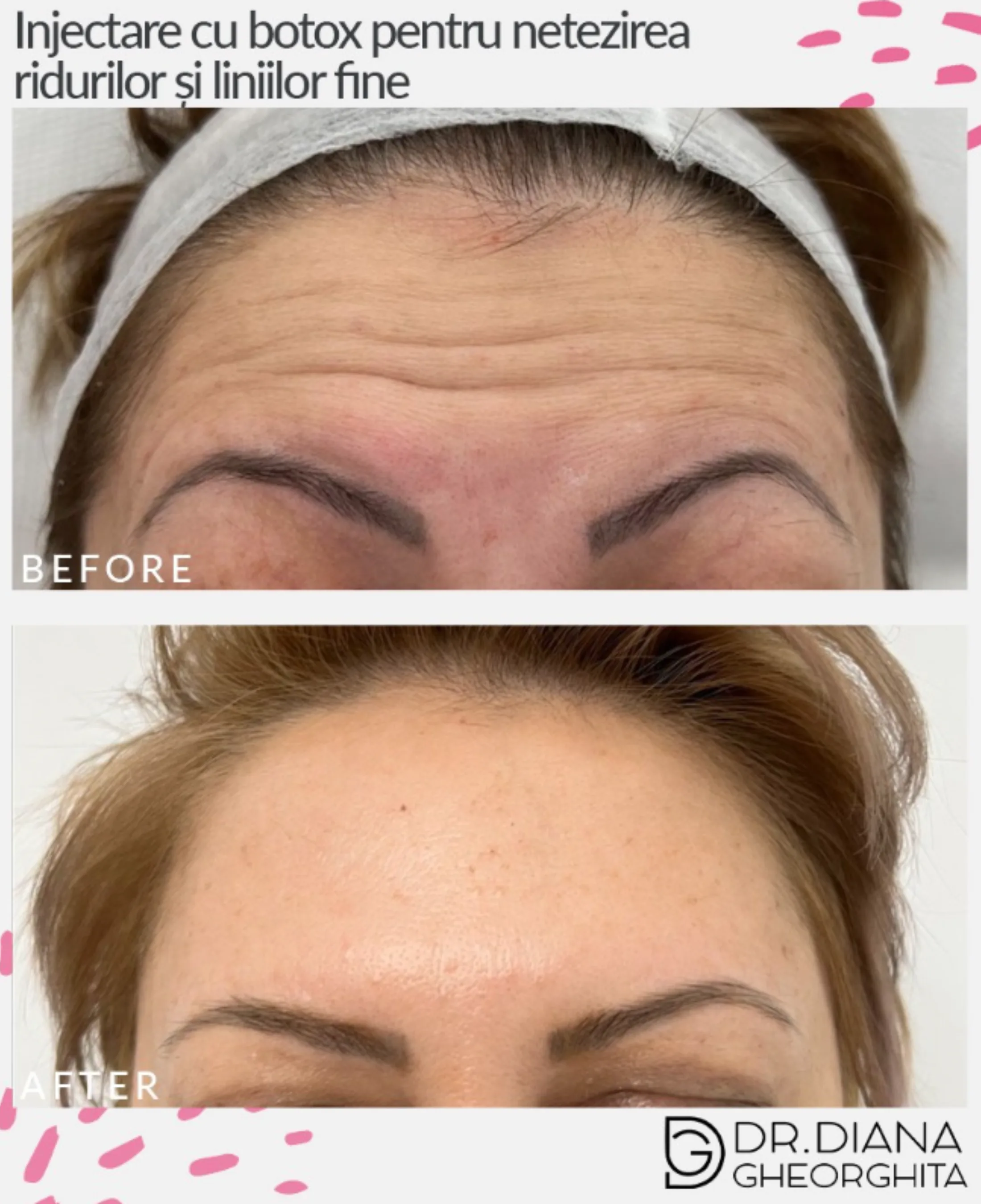 injectare toxina botulinica