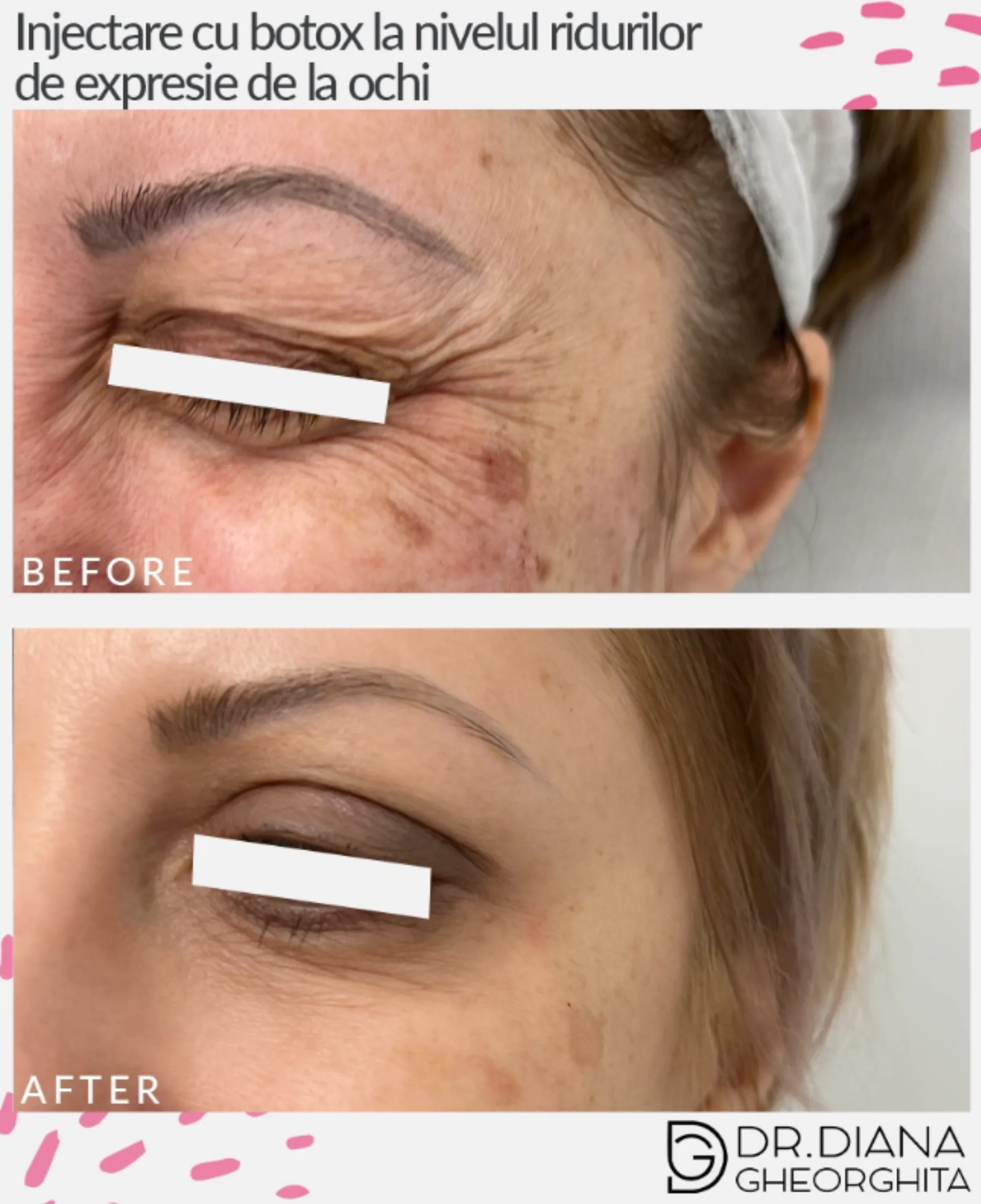 injectare toxina botulinica