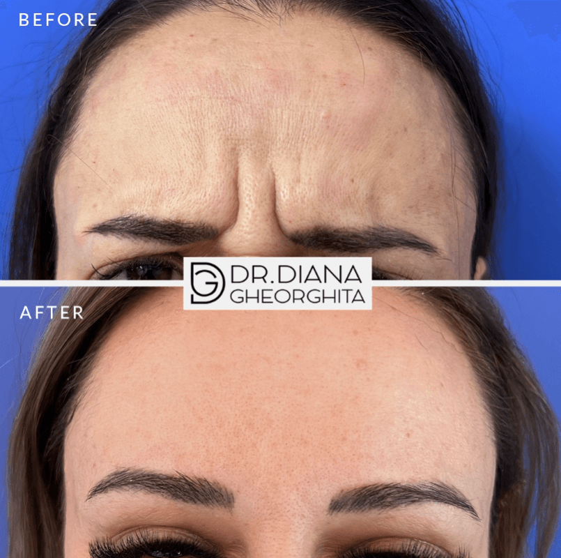 Tratament riduri riduri