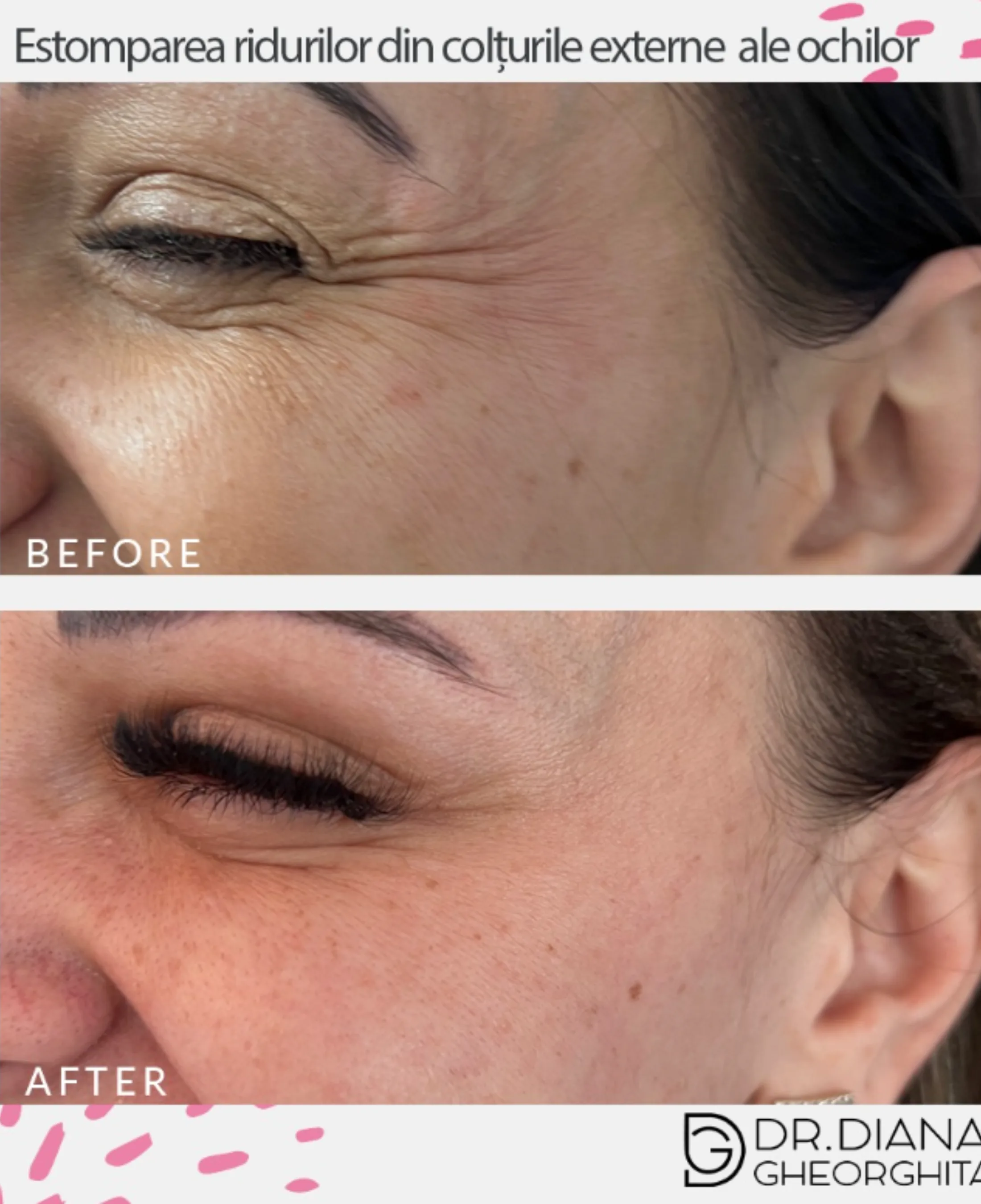 injectare toxina botulinica