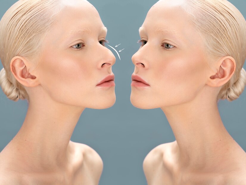Rinoplastie: la ce să te aștepți înainte și după operație rinoplastie inainte si dupa