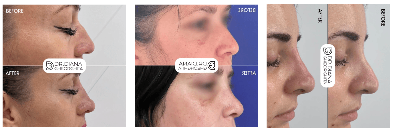 rinoplastie inainte si dupa