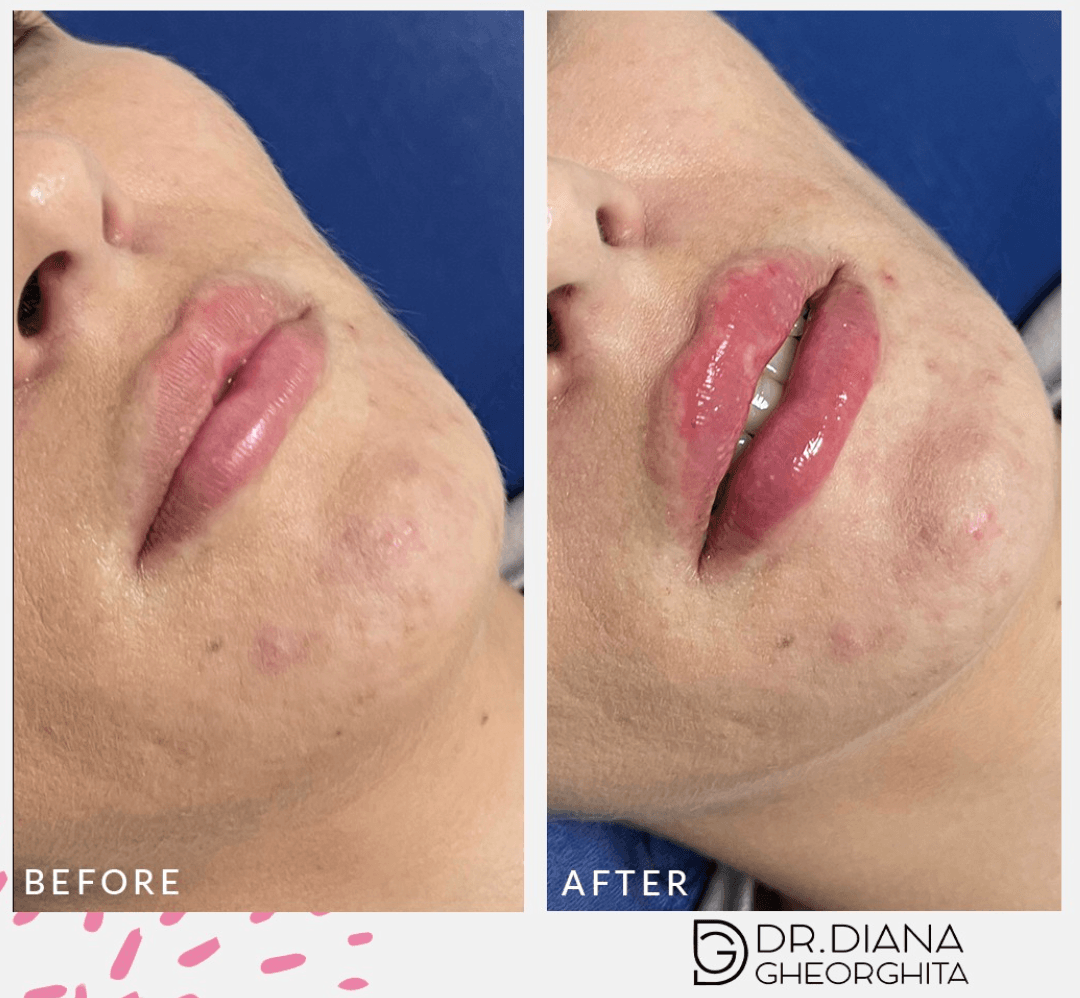 Tipuri de buze cu acid hialuronic buze cu acid hialuronic