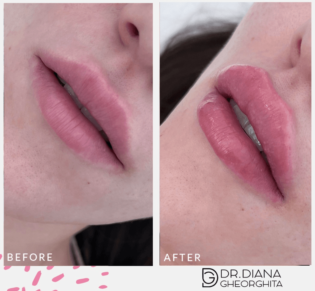 Tipuri de buze cu acid hialuronic buze cu acid hialuronic