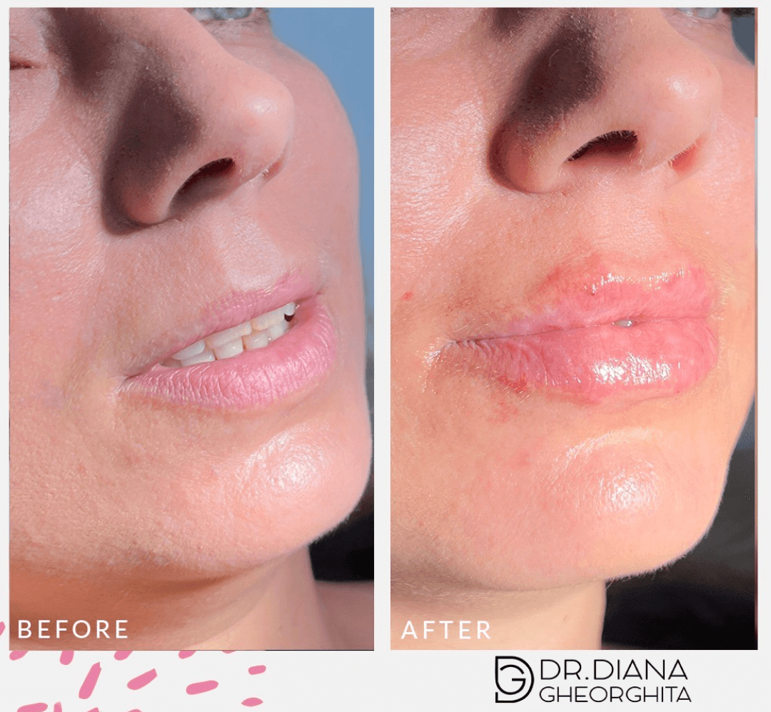 Tipuri de buze cu acid hialuronic buze cu acid hialuronic