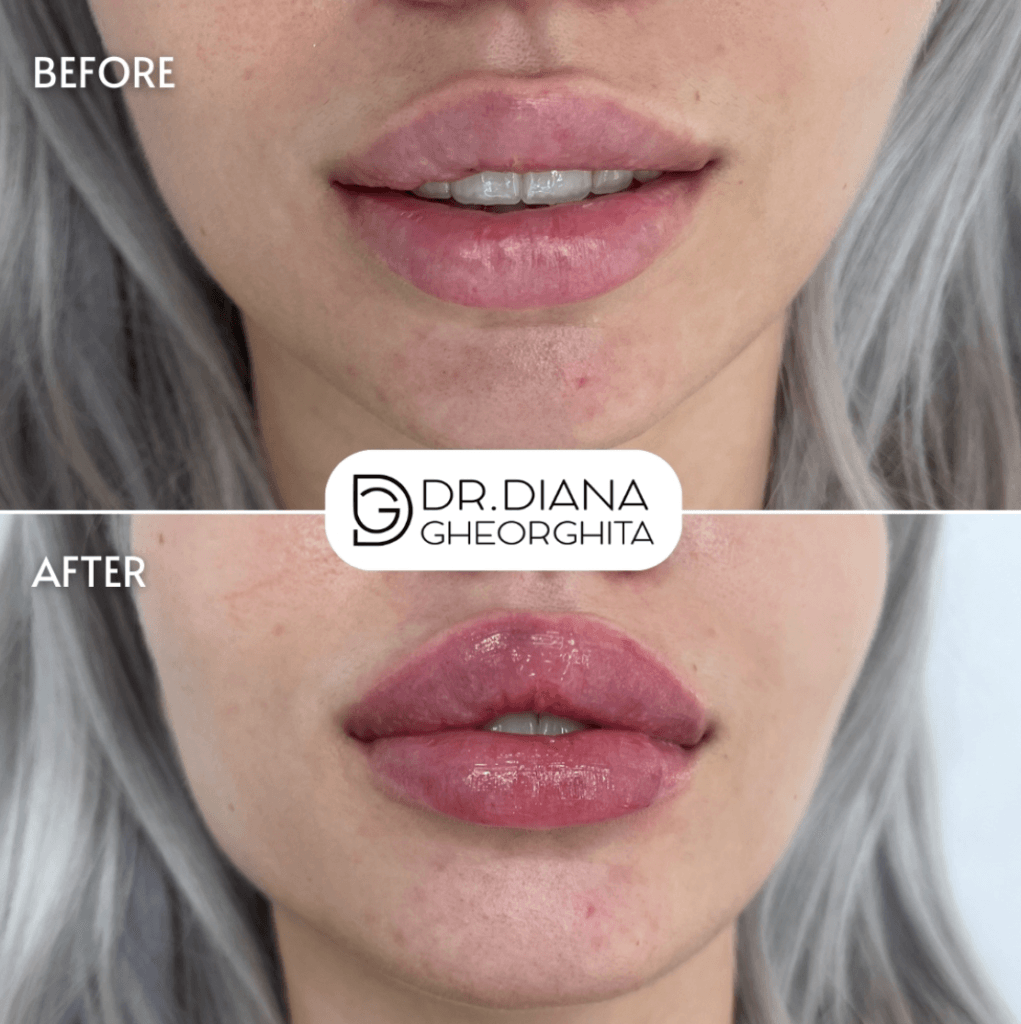 buze cu acid hialuronic