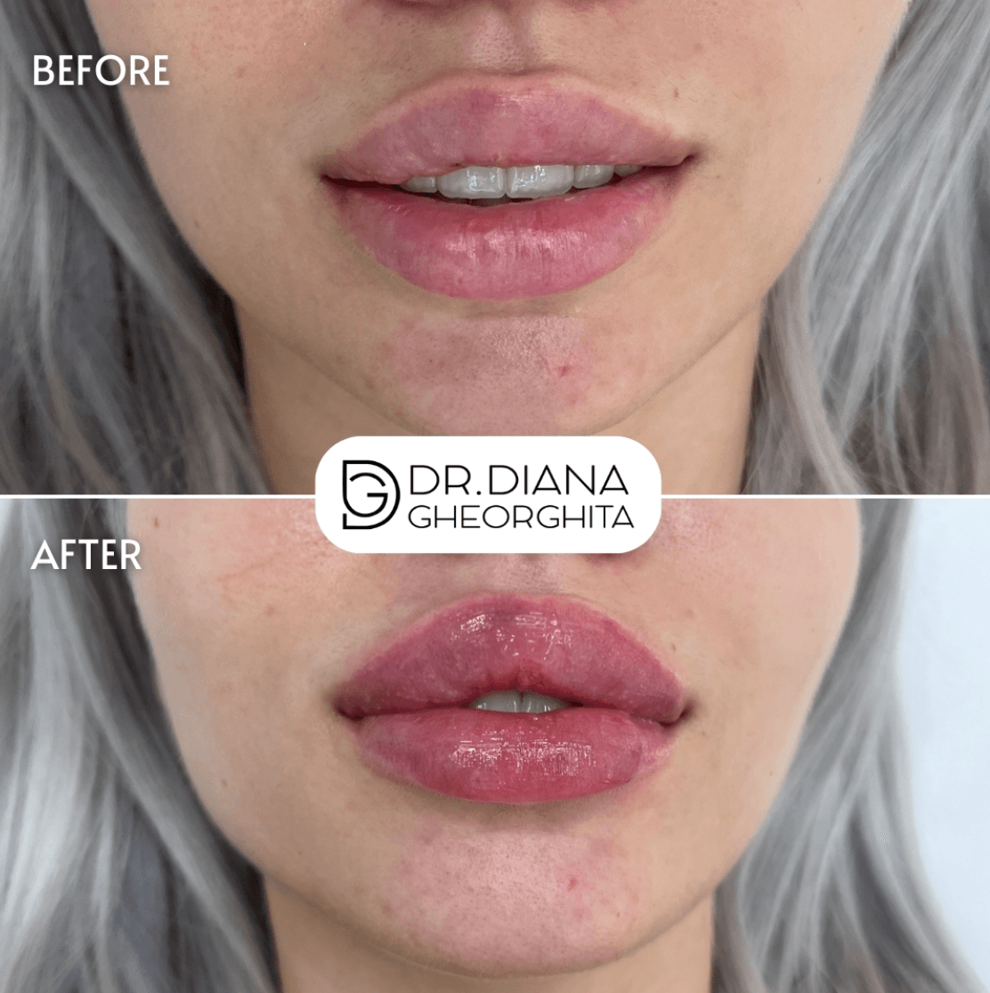 buze cu acid hialuronic