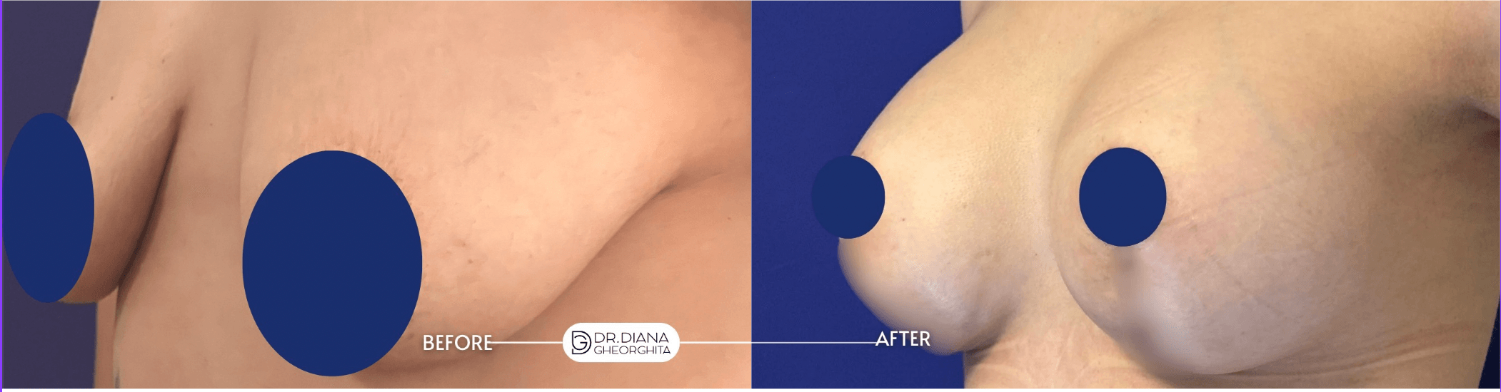 Mărire sâni cu implant mamar implant mamar poze