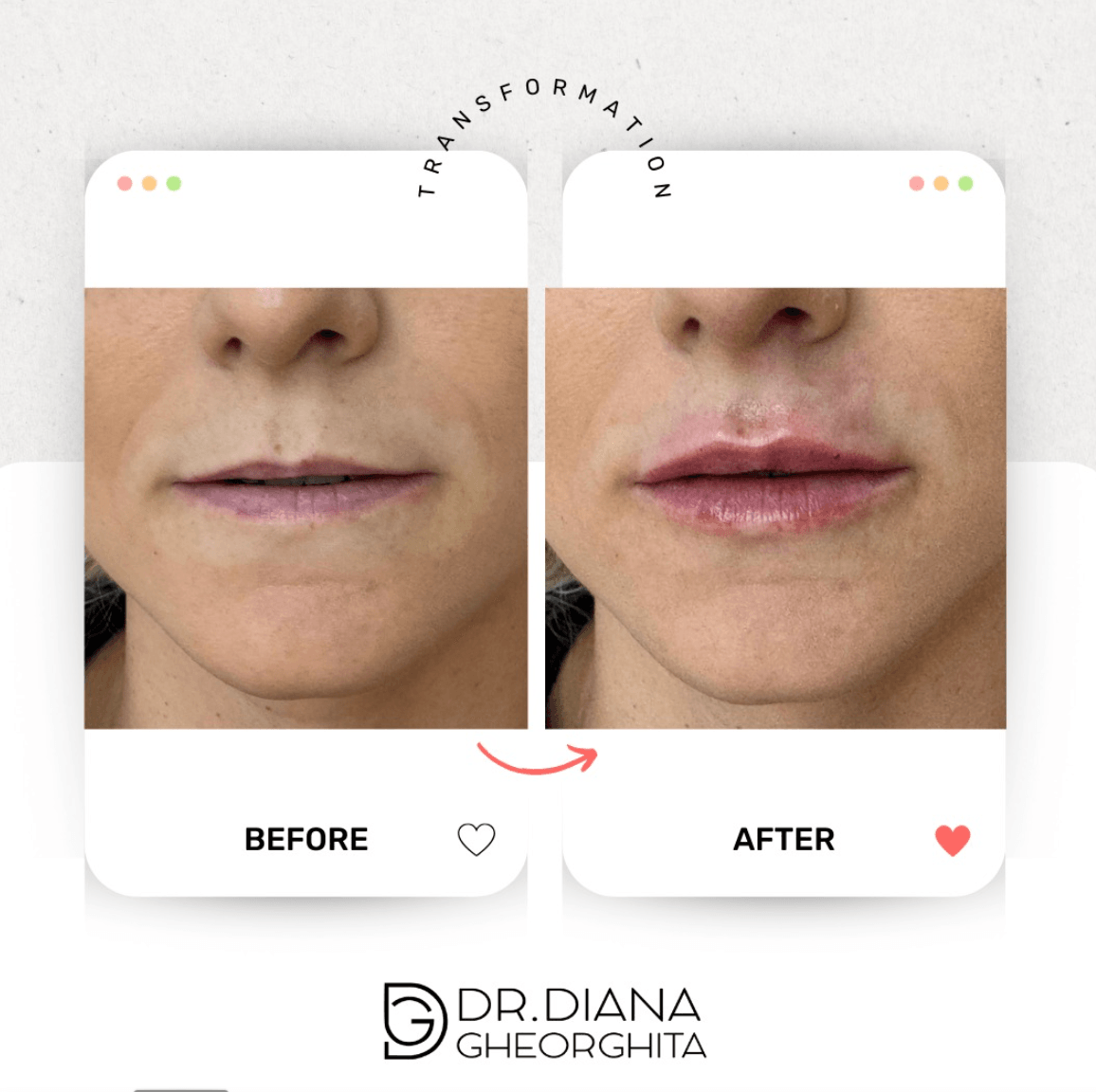 Ce rezultate poți aștepta după 1 ml de acid hialuronic?