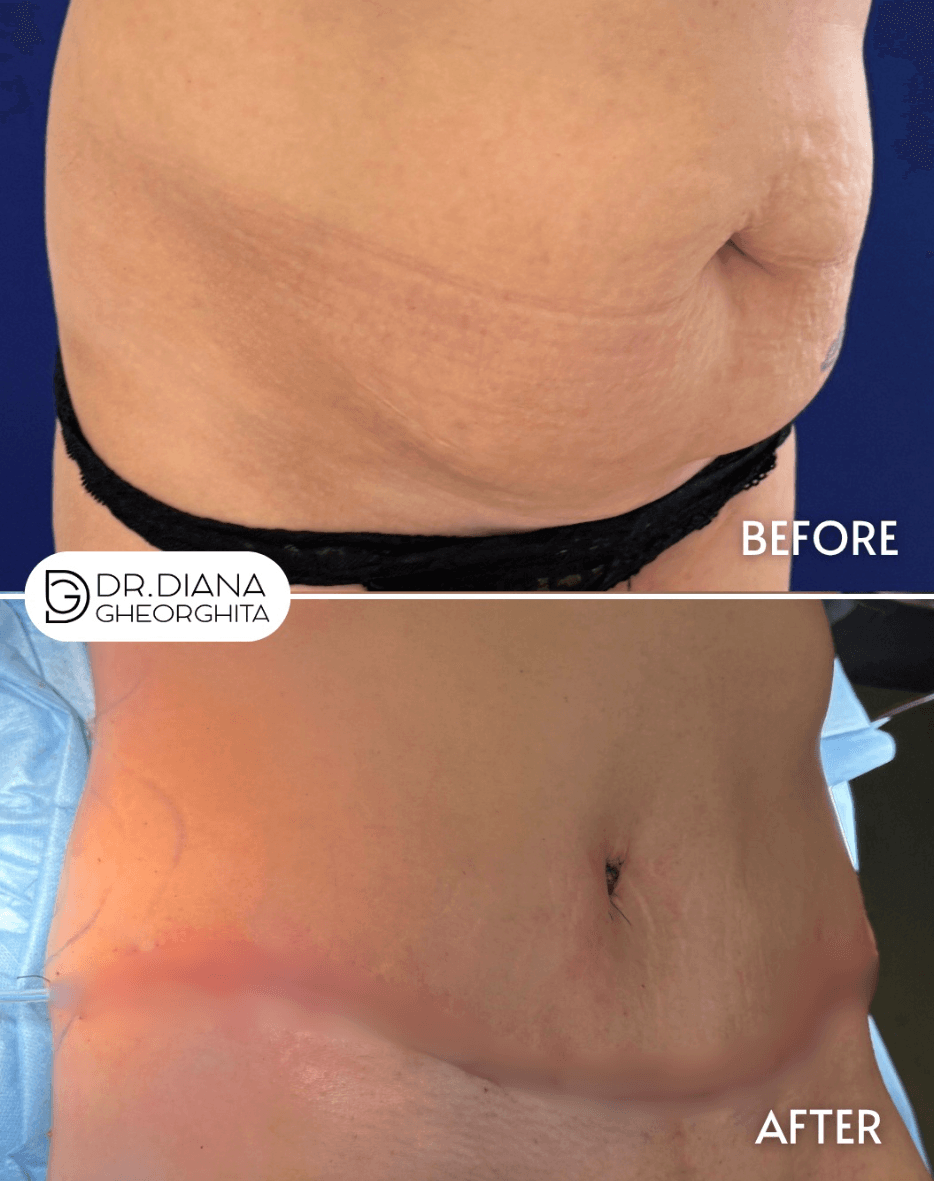 poze cu abdominoplastia cu liposucție înainte și după
