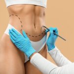 Abdominoplastie vs liposucție – Cum alegi procedura care îți transformă silueta
