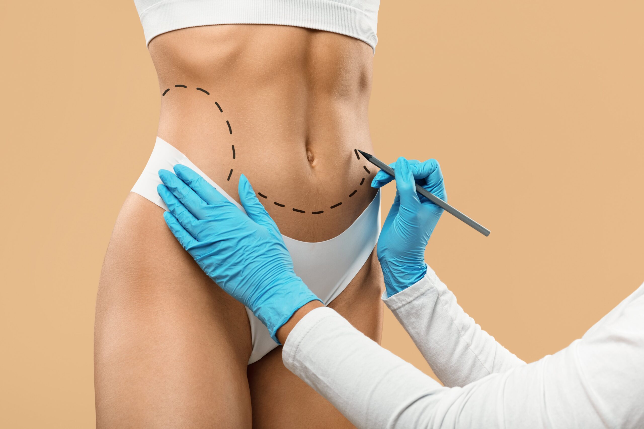 Abdominoplastie vs liposucție – Cum alegi procedura care îți transformă silueta