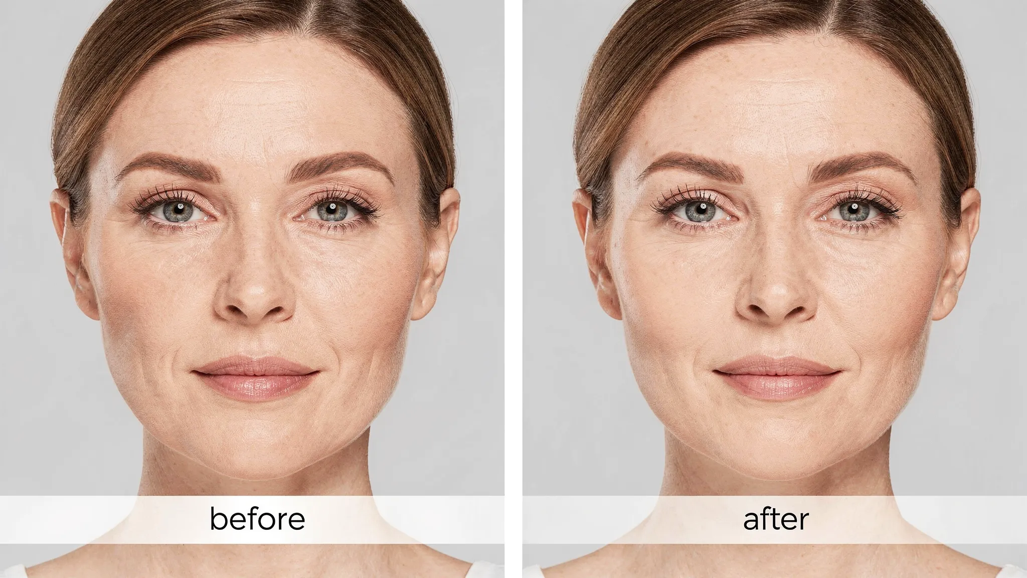 Lipofilling facial: păreri, rezultate și cât durează